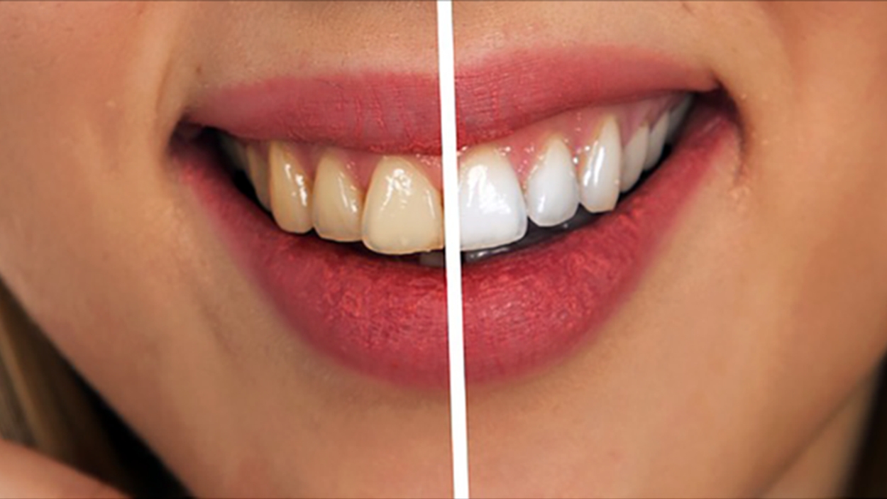 Miracles of Teeth Whitening-systeem