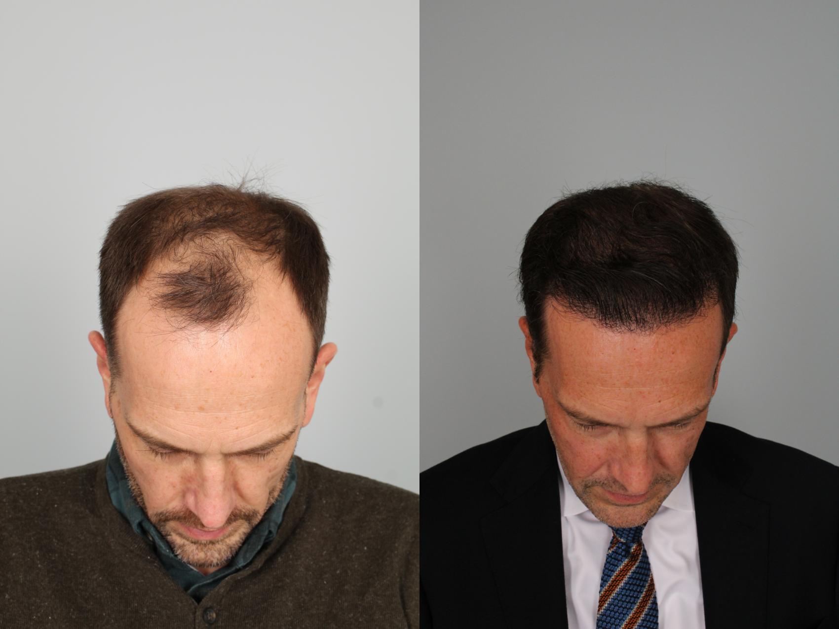 Confidence in Every Strand: London’s Leading Hair Transplant Clinics