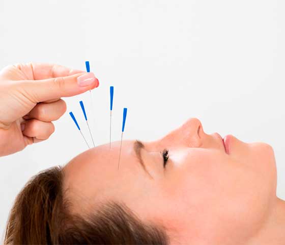 Aligning with Nature: Traditional Chinese Acupuncture in Milton