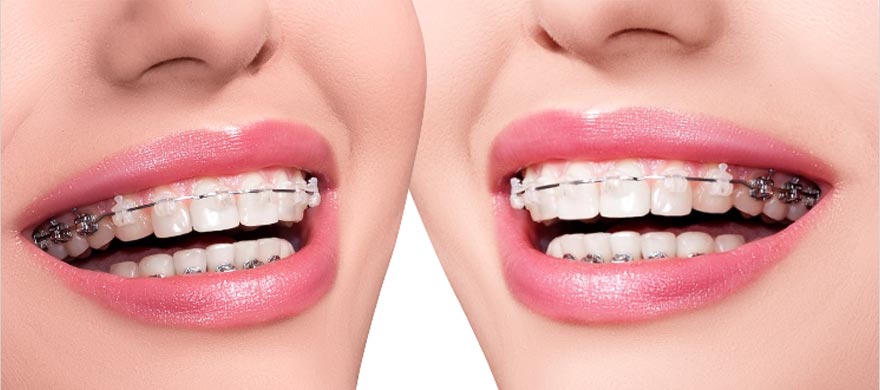 יישור שיניים שקוף מחיר באמריקן סמייל: חווית יישור השיניים הכי מתקדמת